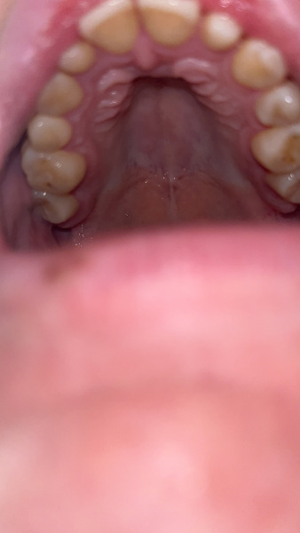 Any dentists about or GPs? Small hard lump roof of mouth