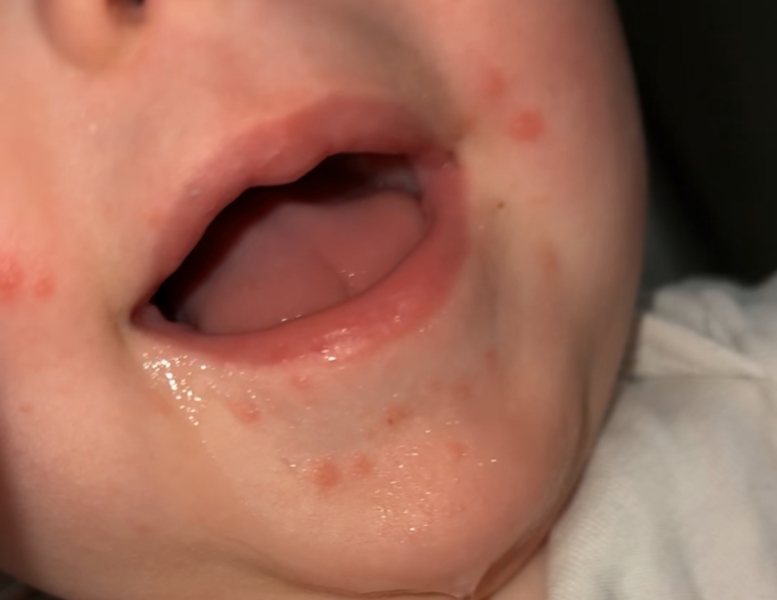 Heat rash? Teething rash? Hand, foot & mouth?
