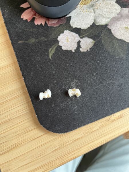 DD’s tooth (already fallen out) spontaneously broke in half