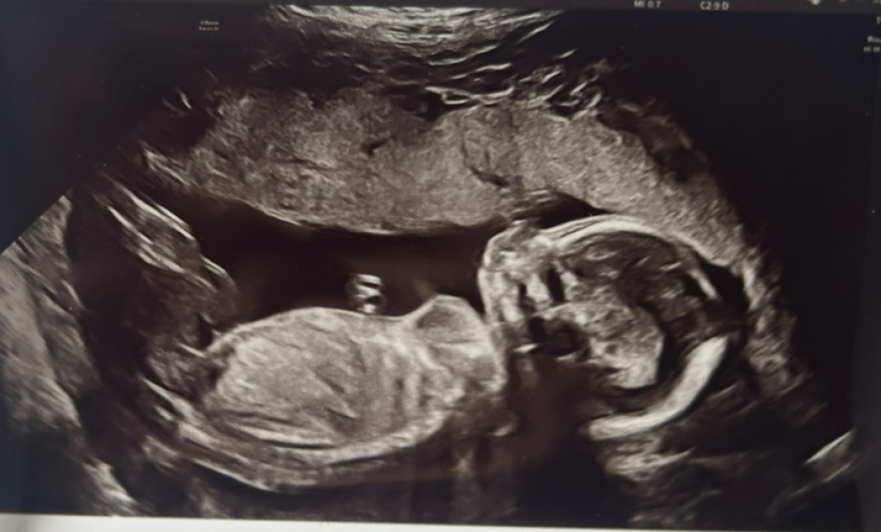 20wk scan side profile
