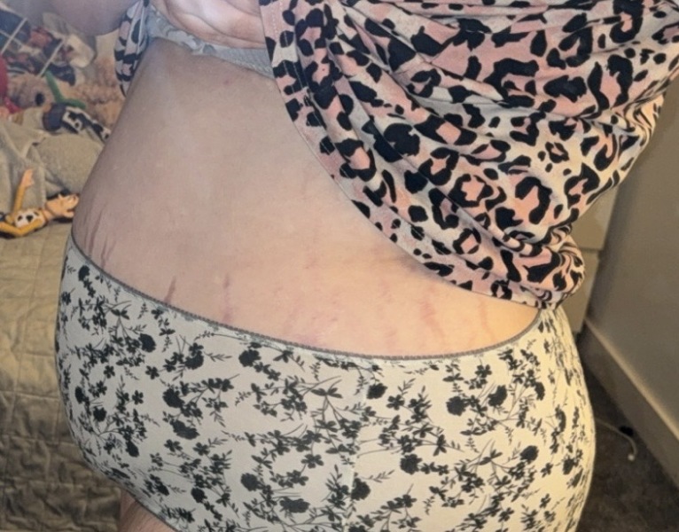 Bump At 9-10 Weeks??