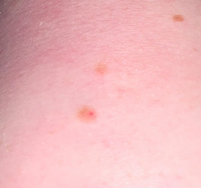 Red dot in a mole