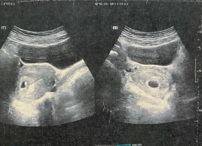 Had an ultrasound today. Is this black bean my baby?