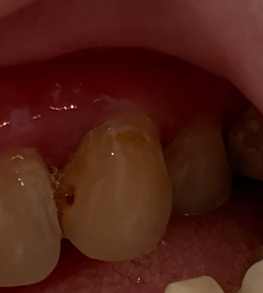 Spot on tooth…