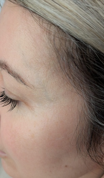 Veins around eye