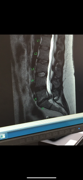 Sciatica hell. What might help?