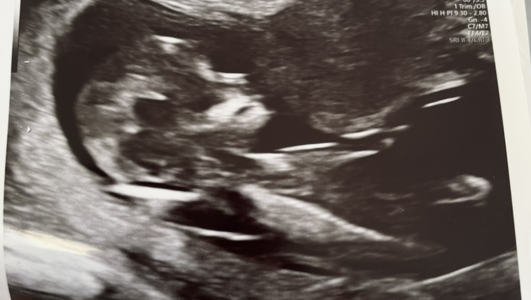 1 in 4 chance of DS - CVS tomorrow