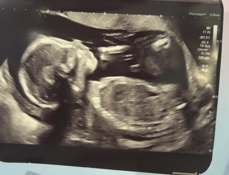 Nub Theory. Boy or Girl?