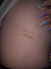 Rash all over breasts and torso