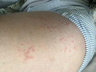 Anyone any good with rashes? What could this be?