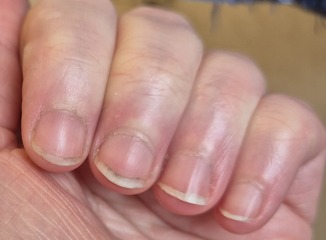 Pale fingernails