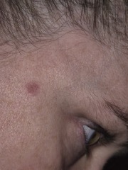 Weird mark on face - doctors?