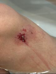 Are there any nurses / medical people here? What is this? *Warning, photo attached