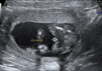 Definitely a boy?