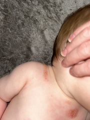My baby’s eczema