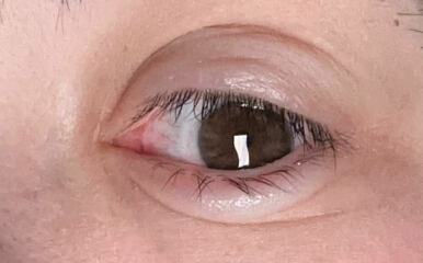 Corneal erosion is driving me insane.