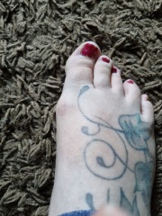 Bunion??