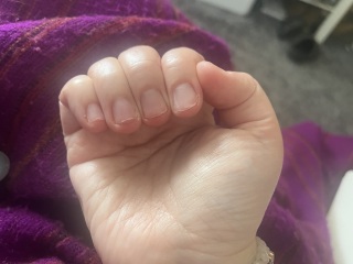 What is happening to nails and how to fix?