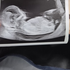 13 week scan gender prediction?