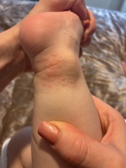 Is this chicken pox or HFM or something else?