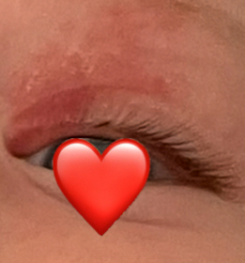 My little DDs swollen eyelid (do I need to worry)