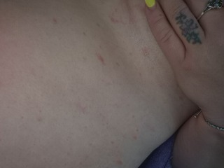 Rash