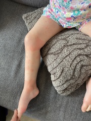 Erythema Multiforme?