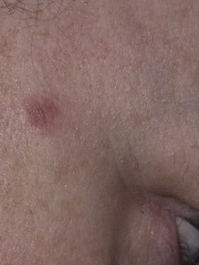 Weird mark on face - doctors?