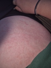 Pityriasis rosea