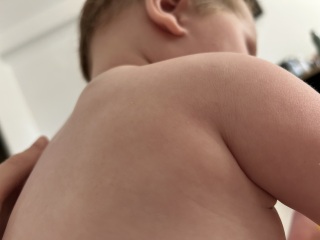 Lump/bruise on shoulder blade?