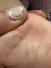 Is this a wart on hand ?!