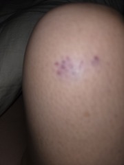 Bruise
