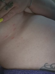 Rash