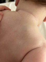 Lump/bruise on shoulder blade?