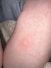 Bites or hives??
