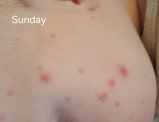 Is this chickenpox?