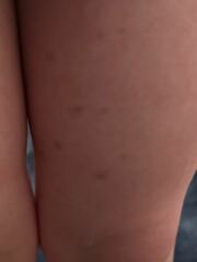 Skin rash on 4 year old?