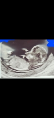 12 weeks 3 days - gender guess