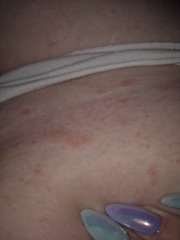 Rash all over breasts and torso