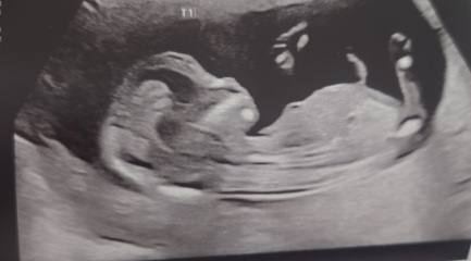 Gender guess for twins??