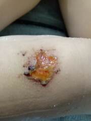 Does my son’s knee scrape look infected?