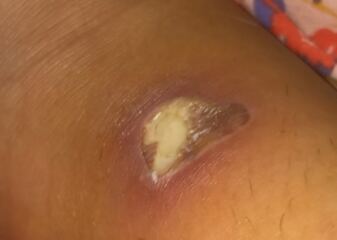 What kind of burn is this gross pic attatched