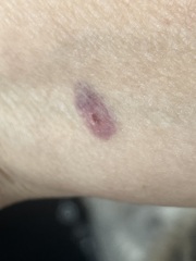 Is this a bite, scratch or something else?