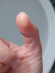 Wart or blood blister on thumb?