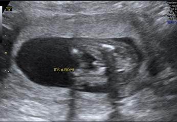 Definitely a boy?