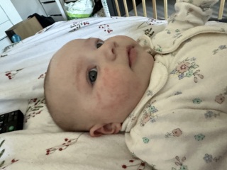 3 month old baby acne?