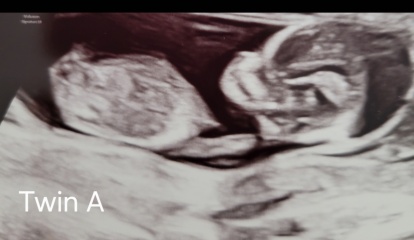 Guess the Sex of my Twins??
