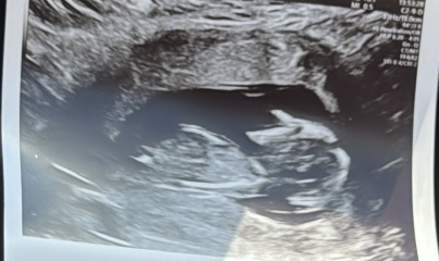13 week scan, feeling worried