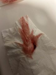 Is this a miscarriage? 14 weeks and clots? Picture