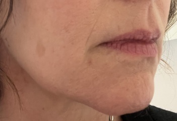 Saggy mouth and jaw help needed (pic attached)